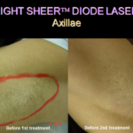 Light Sheer Diode Laser Dermatological SurgiCenter