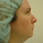 Liposuction Dermatological SurgiCenter