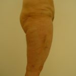 Liposuction Dermatological SurgiCenter