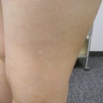 IPL Leg Dermatological SurgiCenter