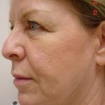 Laser Removal Birthmark Dermatological SurgiCenter