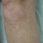 Sclerotherapy Dermatological SurgiCenter